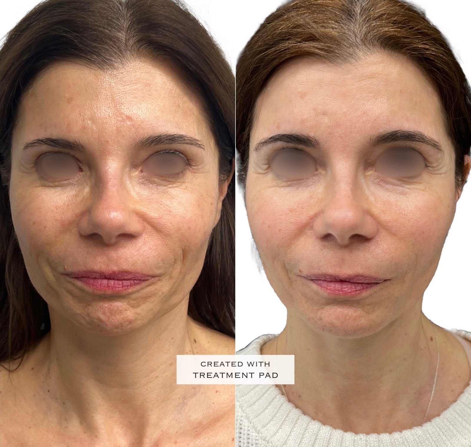EXION Facial — antes e depois