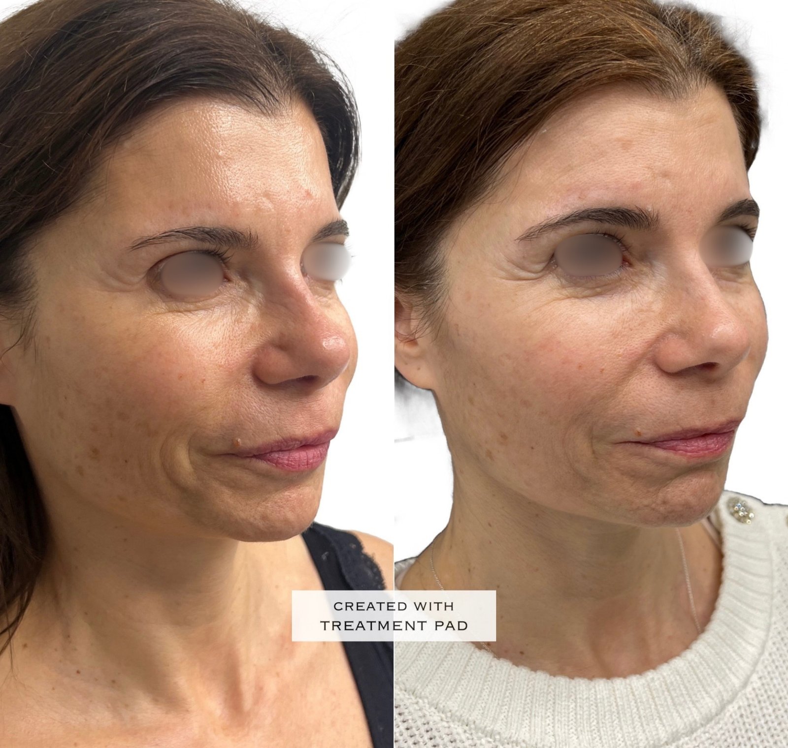 Radiofrequência microagulhada — antes e depois